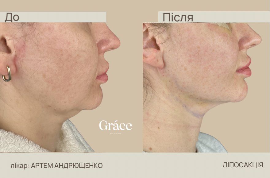Before / after surgery