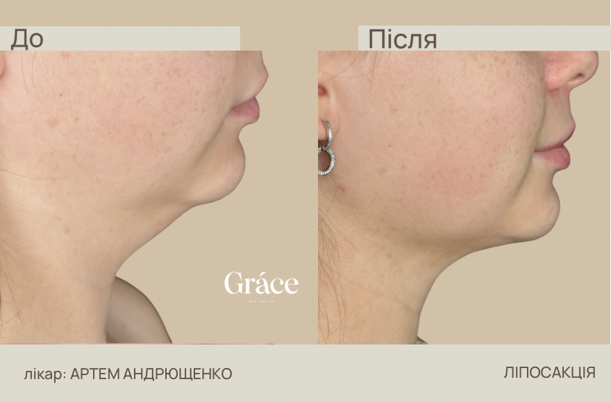 Before / after surgery
