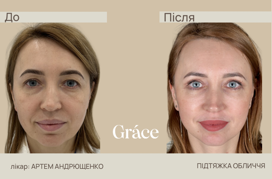 Before / after surgery